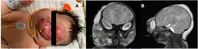 An unusual presentation of neonatal rhabdomyosarcoma: a case report